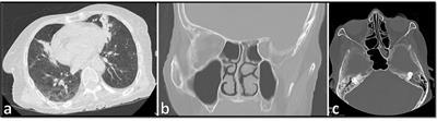 Case report: COVID-19-associated mucormycosis co-infection with Lomentospora prolificans: The first case and review on multiple fungal co-infections during COVID-19 pandemic